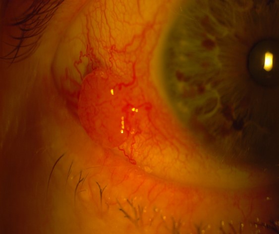 Conjunctival MM_Melanoma of the eye