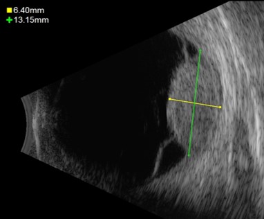 UM ultrasound_Melanoma of the eye